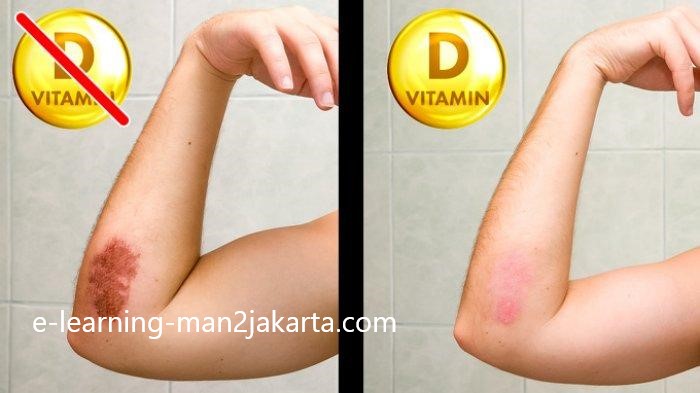 5 Tanda Kamu Kekurangan Vitamin Tanpa Sadar
